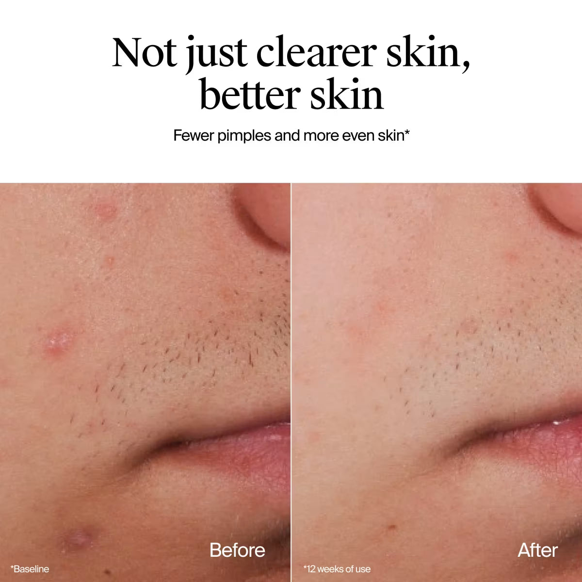 Neutrogena® Oil-Free Acne Wash, Fragrance Free 9.1 FL. Oz - US 6463